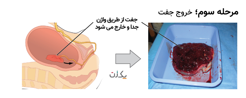 خروج جفت -مرحله ی سوم زایمان طبیعی